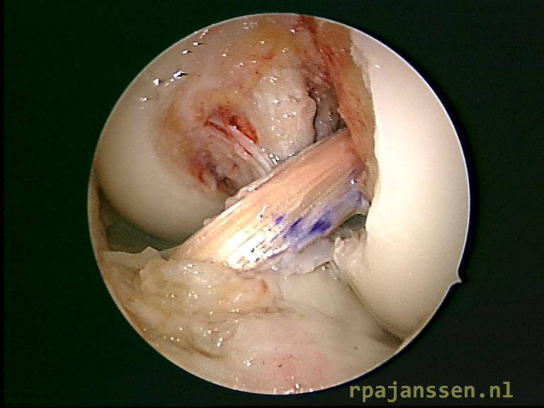 Arthroscopic view of anatomic anterior cruciate ligament reconstruction (with purple marking)