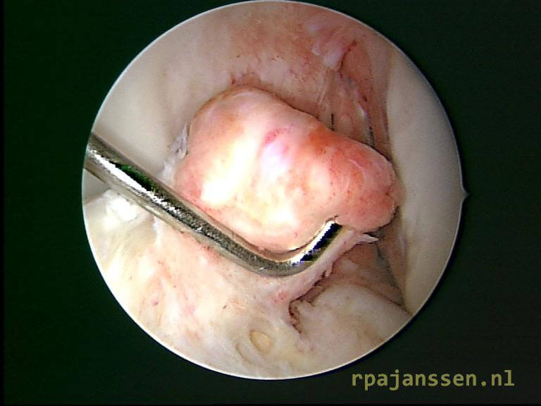 Arthroscopic view of ruptured anterior cruciate ligament