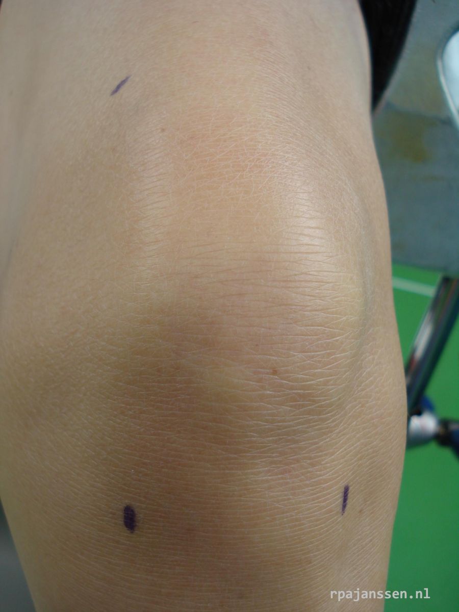 Arthroscopy: 3 small skin incisions