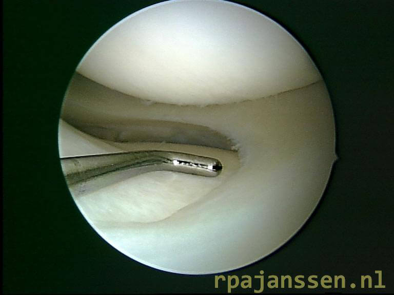 Arthroscopie: haakje wijst naar meniscus tussen boven-en onderbeen