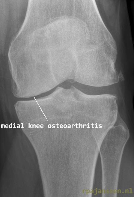 X-ray knee with medial osteoarthritis