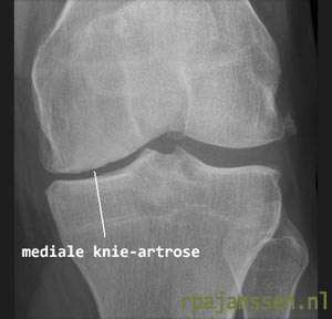 Röntgenfoto knie met mediale artrose